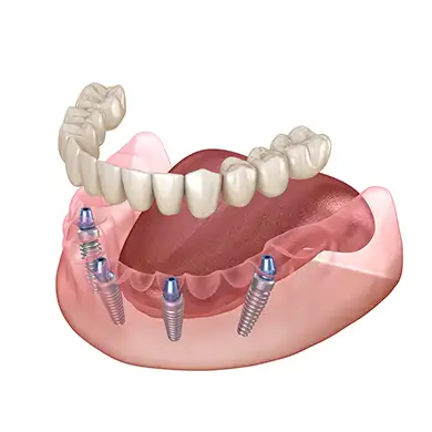 Имплантат All on Four