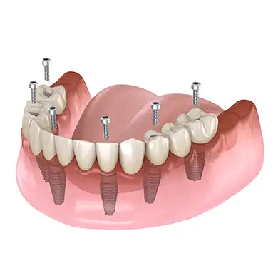 Имплантат All on Six